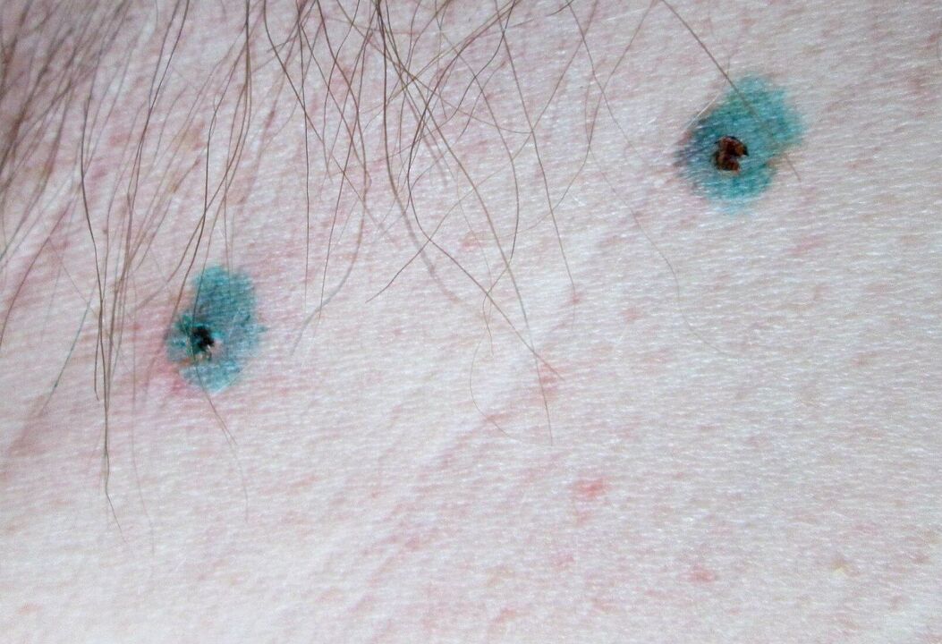 Marques sur la peau après élimination au laser des papillomes